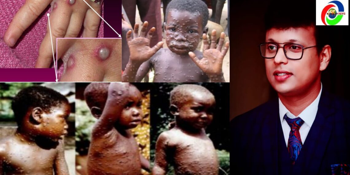 कोरोना के बाद 19 देशों में पैर पसार चुके वायरस मंकी पॉक्स से बचाव व लक्षण के बारे में क्या कहते है डॉ दुगेश नंदन